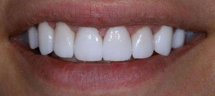 After Veneers — Natasha