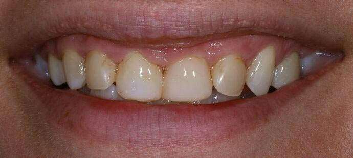 Before Veneers — Natasha