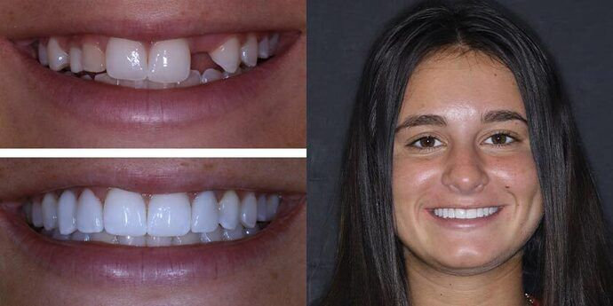 Dental Implants before and after