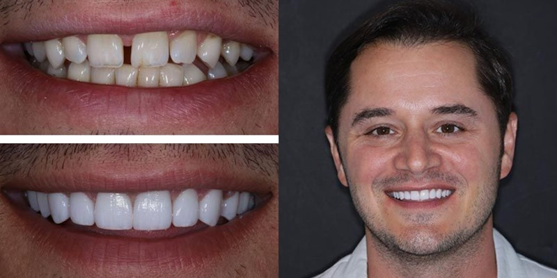Porcelain Veneers