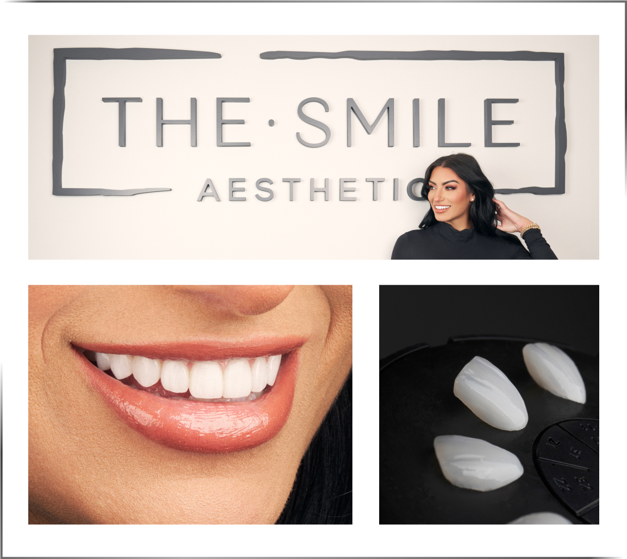 The Smile Aesthetic sign, a veneer smile and porcelain veneers