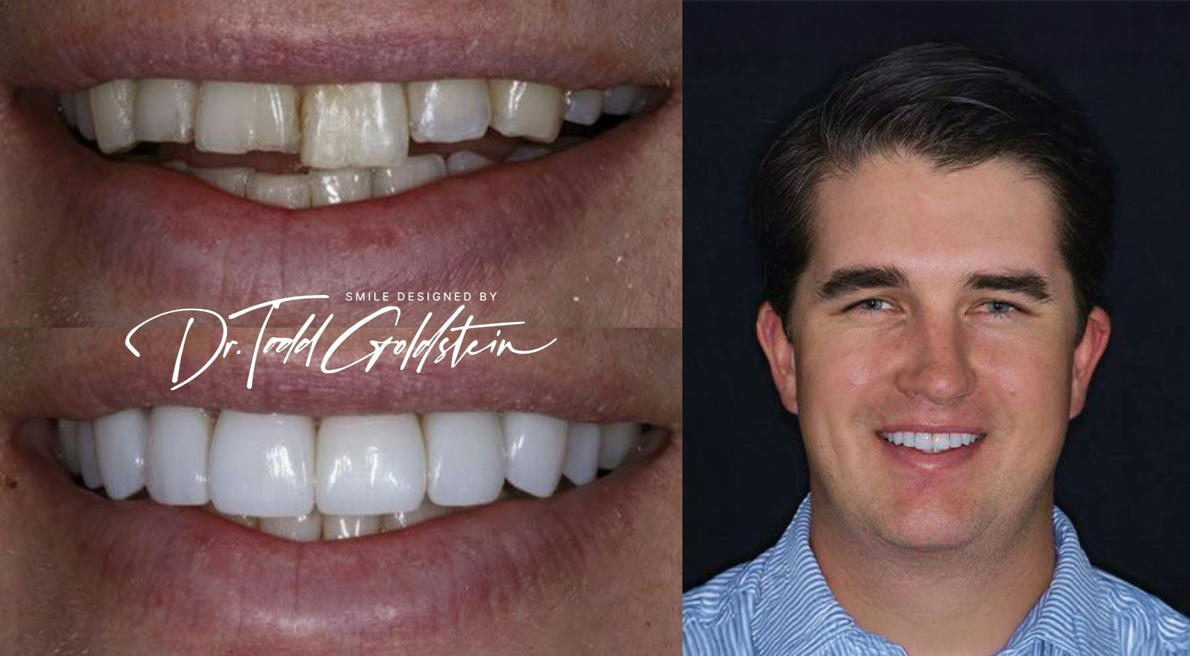 Chipped Teeth before and after veneers