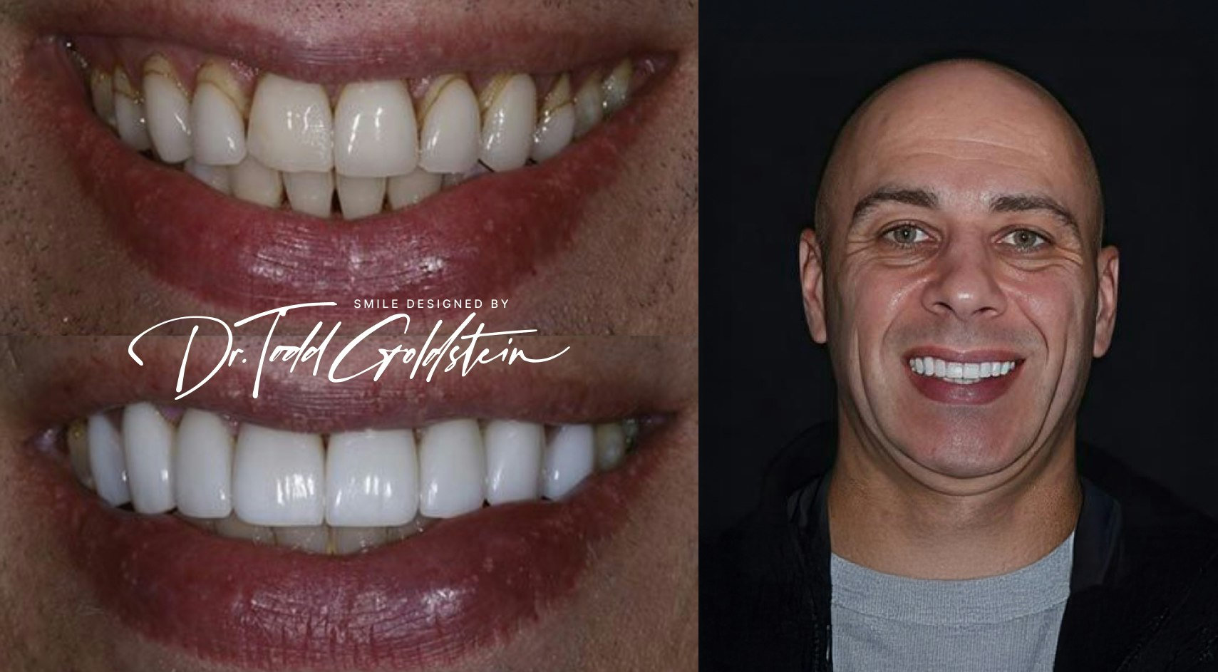 Discoloration before and after veneers