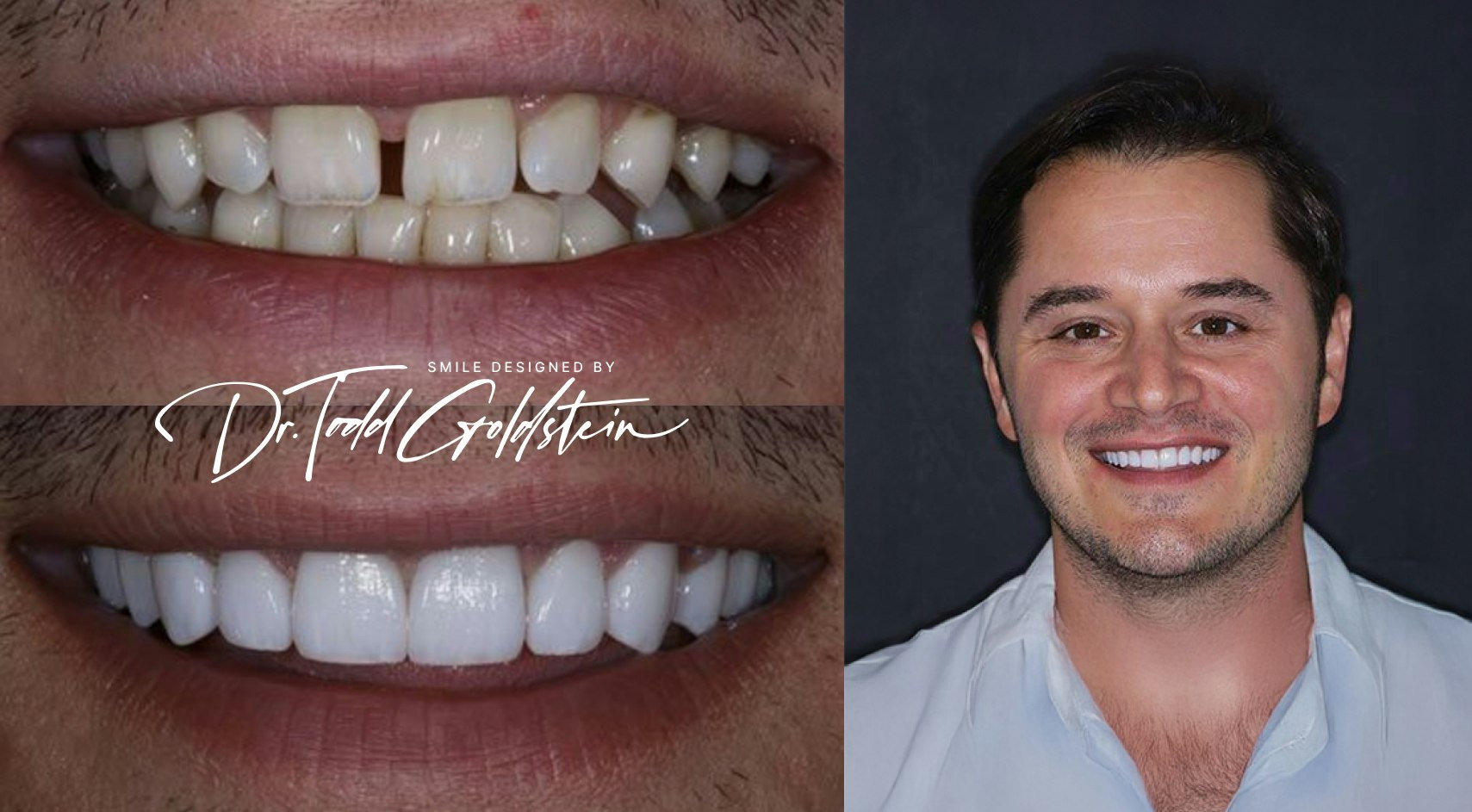 Tooth Gaps before and after veneers
