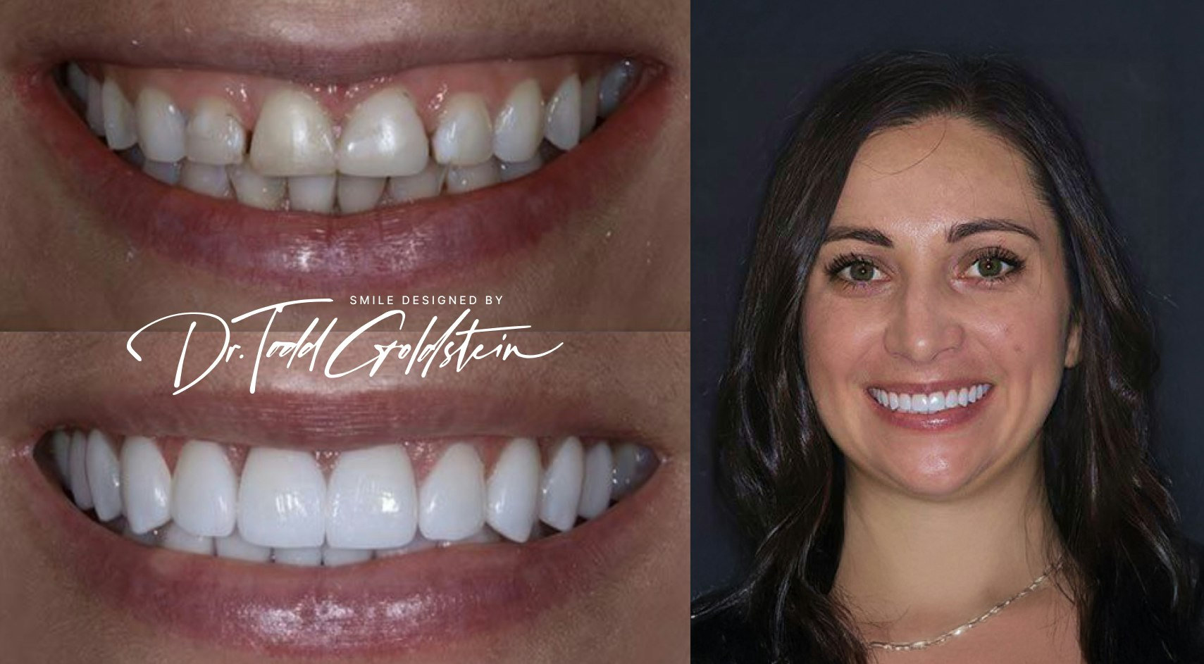 Imbalances before and after veneers
