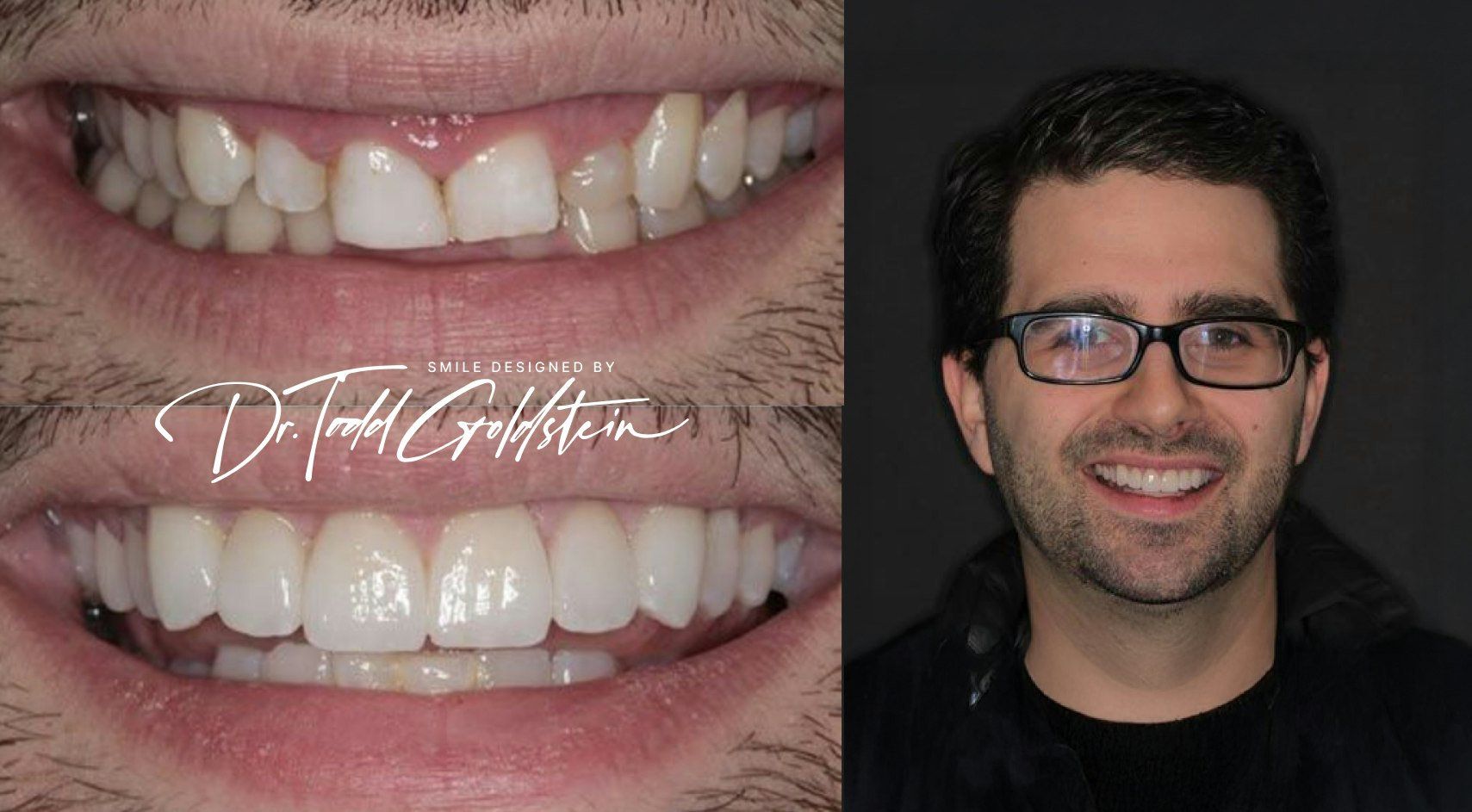 Misalignment before and after veneers