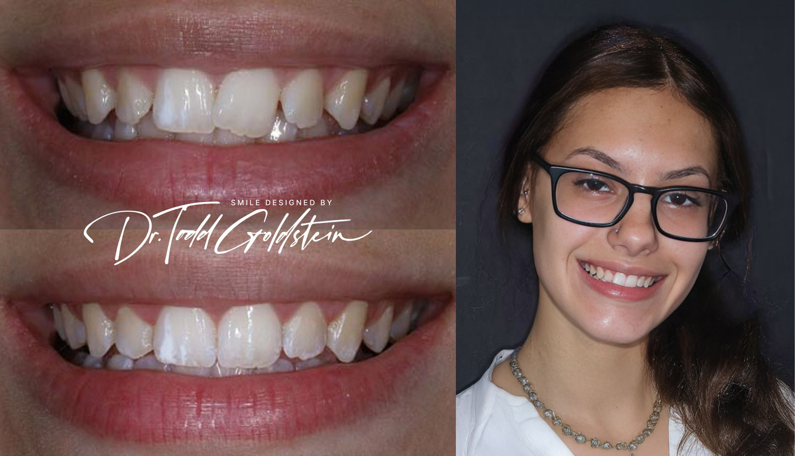 Invisalign — Marissa