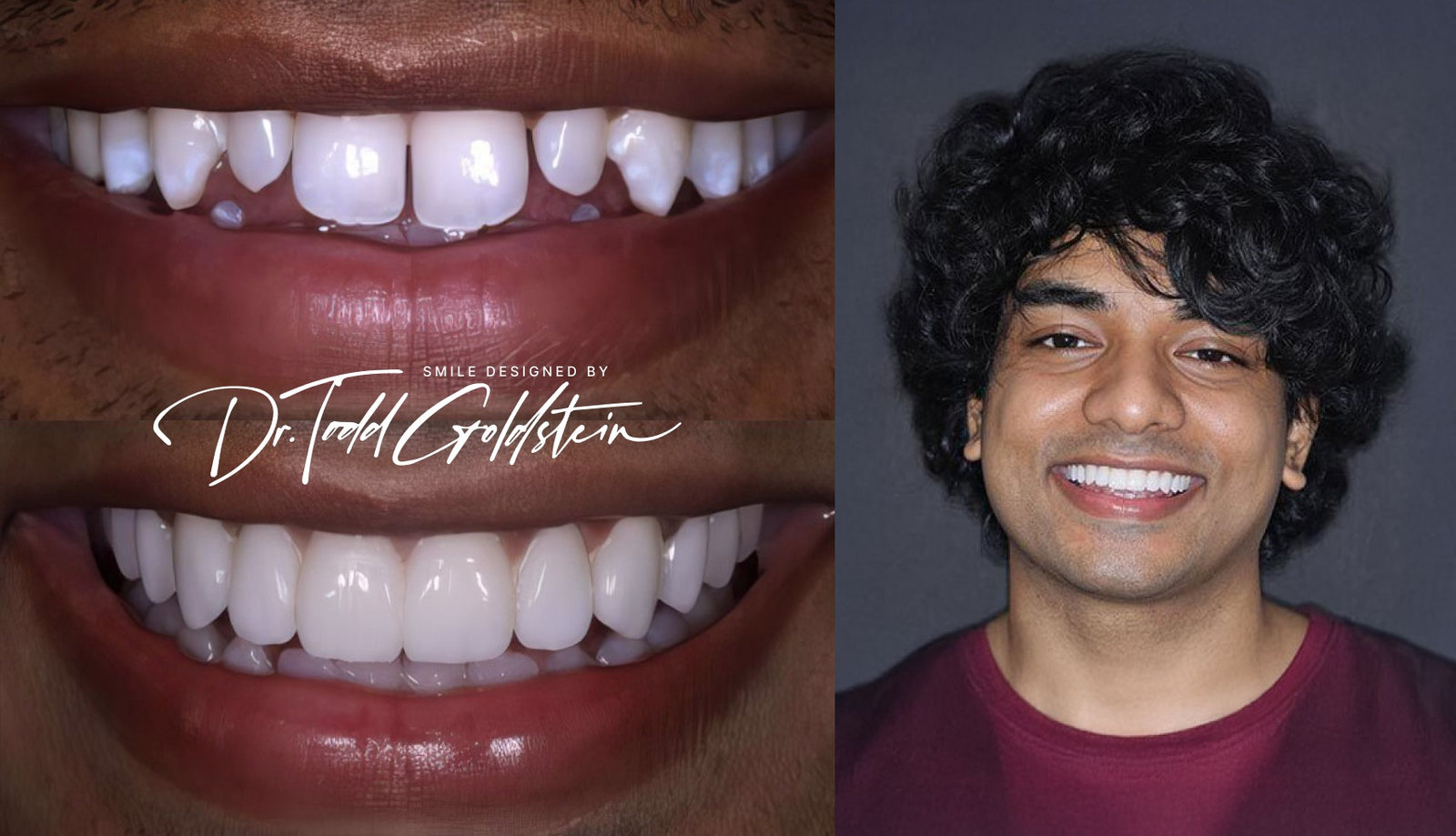 Veneers — Sakib