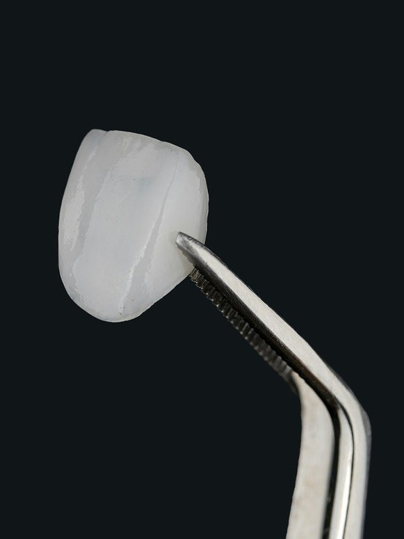 A custom-designed veneer held on a dental instrument